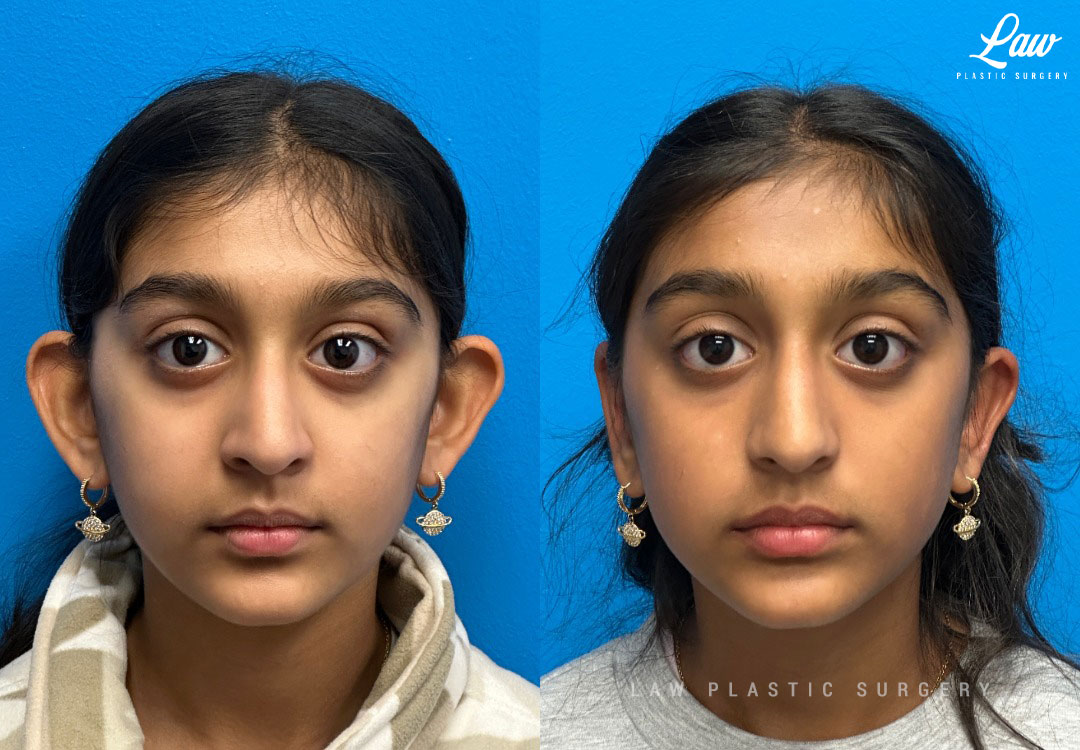 Ear Surgery (Otoplasty) Before & After Photo. Surgery performed in Dallas, TX at Law Plastic Surgery.