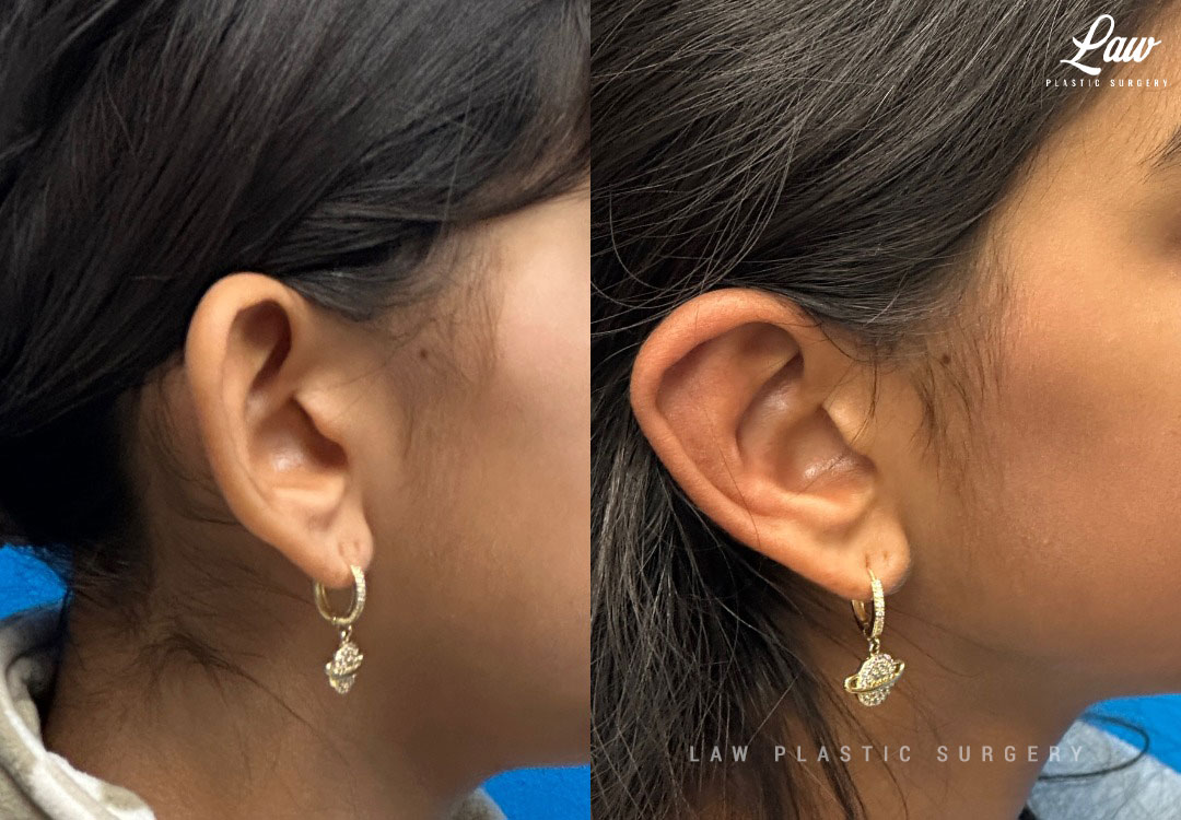 Ear Surgery (Otoplasty) Before & After Photo. Surgery performed in Dallas, TX at Law Plastic Surgery.