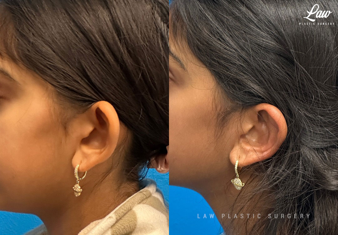 Ear Surgery (Otoplasty) Before & After Photo. Surgery performed in Dallas, TX at Law Plastic Surgery.