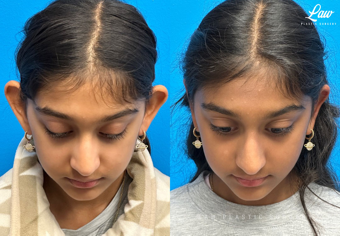 Ear Surgery (Otoplasty) Before & After Photo. Surgery performed in Dallas, TX at Law Plastic Surgery.