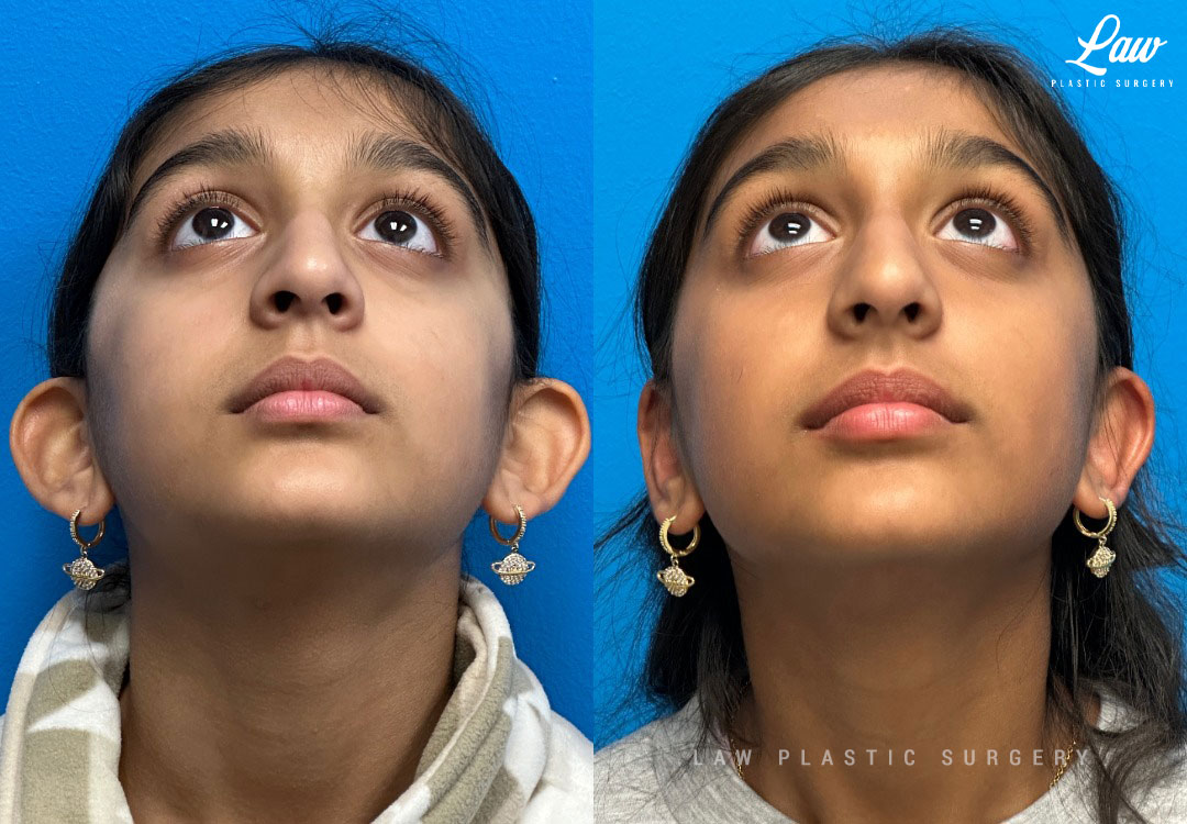 Ear Surgery (Otoplasty) Before & After Photo. Surgery performed in Dallas, TX at Law Plastic Surgery.