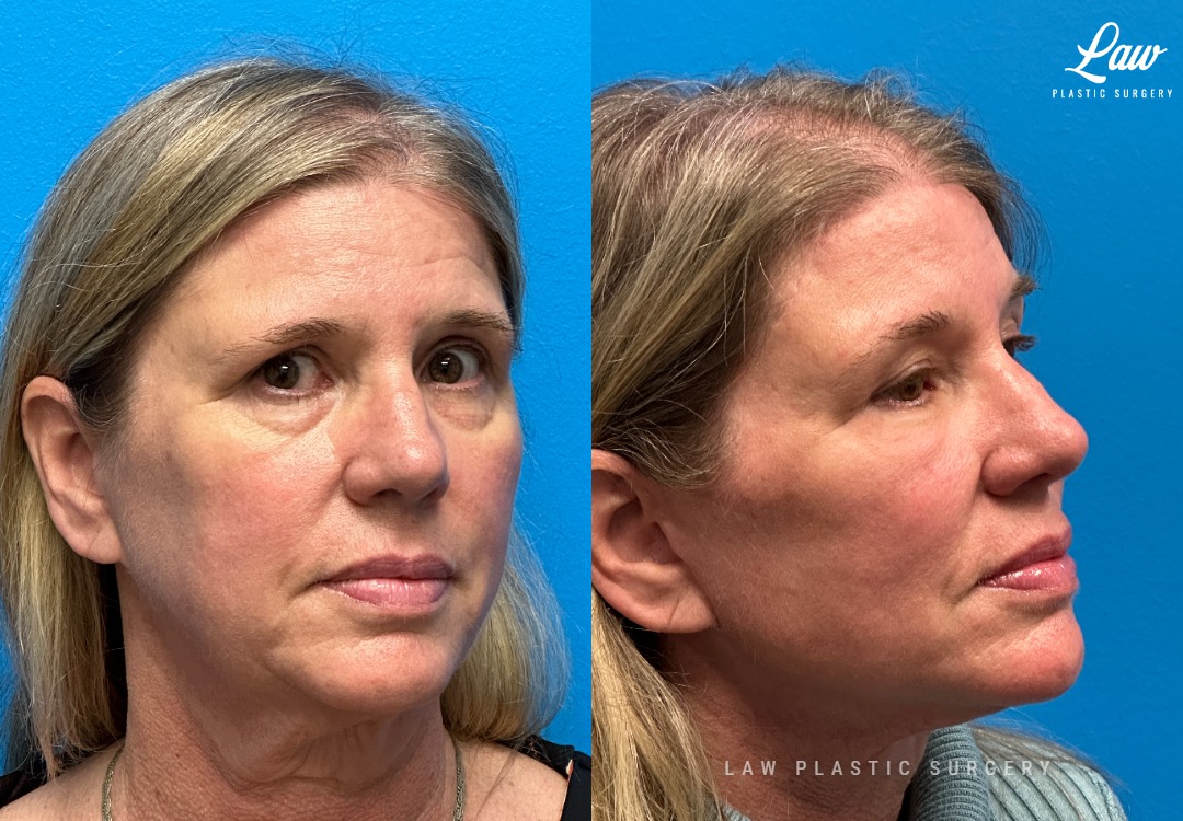 Facelift Before & After Photos. Surgery performed in Dallas, TX at Law Plastic Surgery.