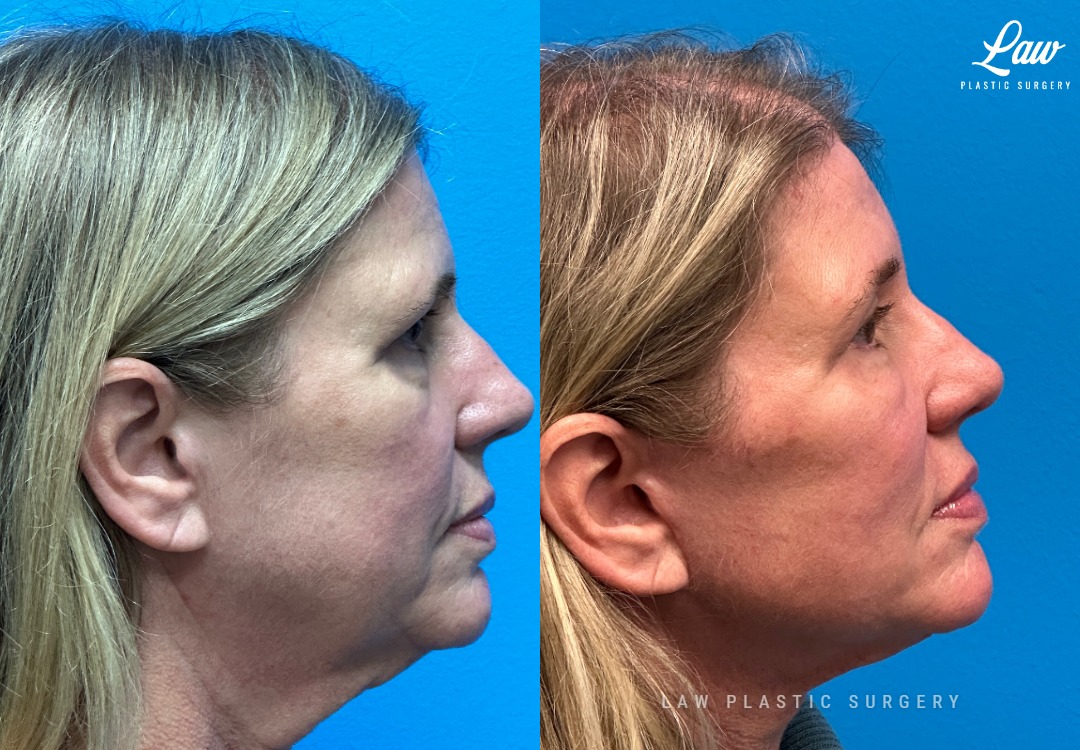Facelift Before & After Photos. Surgery performed in Dallas, TX at Law Plastic Surgery.