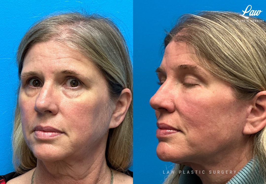 Facelift Before & After Photos. Surgery performed in Dallas, TX at Law Plastic Surgery.
