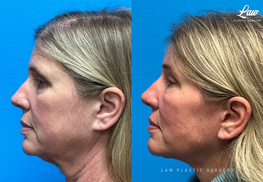 Facelift Before & After Photos. Surgery performed in Dallas, TX at Law Plastic Surgery.