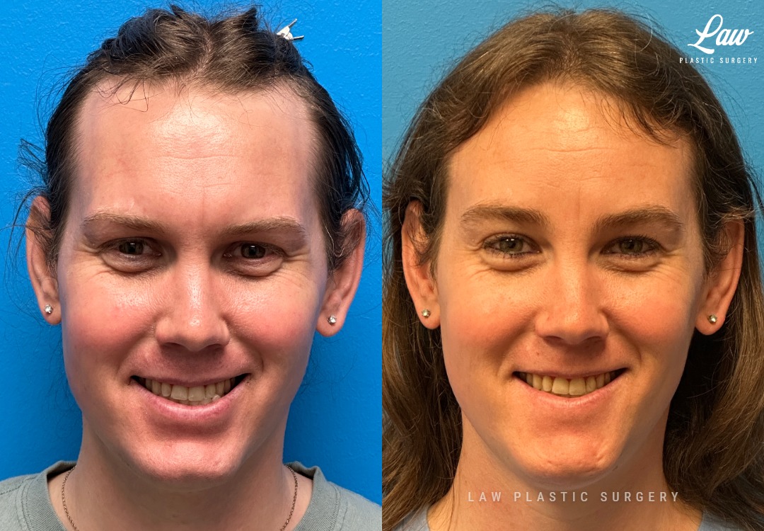 Facial Feminization Before & After Photo. Surgery performed in Dallas, TX at Law Plastic Surgery.