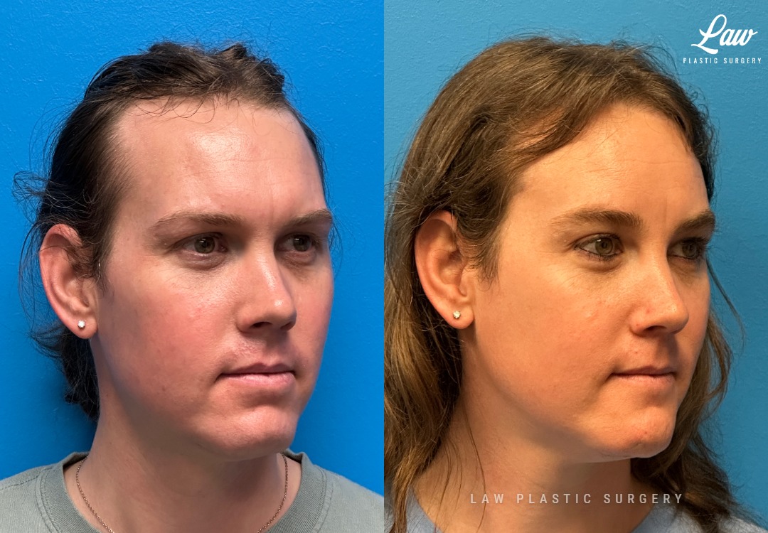 Facial Feminization Before & After Photo. Surgery performed in Dallas, TX at Law Plastic Surgery.