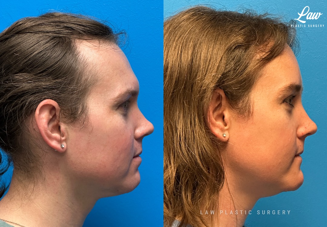 Facial Feminization Before & After Photo. Surgery performed in Dallas, TX at Law Plastic Surgery.
