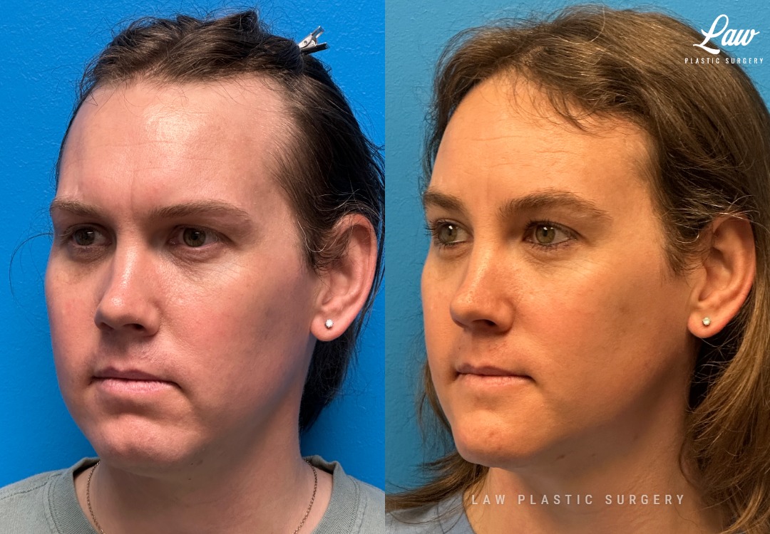 Facial Feminization Before & After Photo. Surgery performed in Dallas, TX at Law Plastic Surgery.
