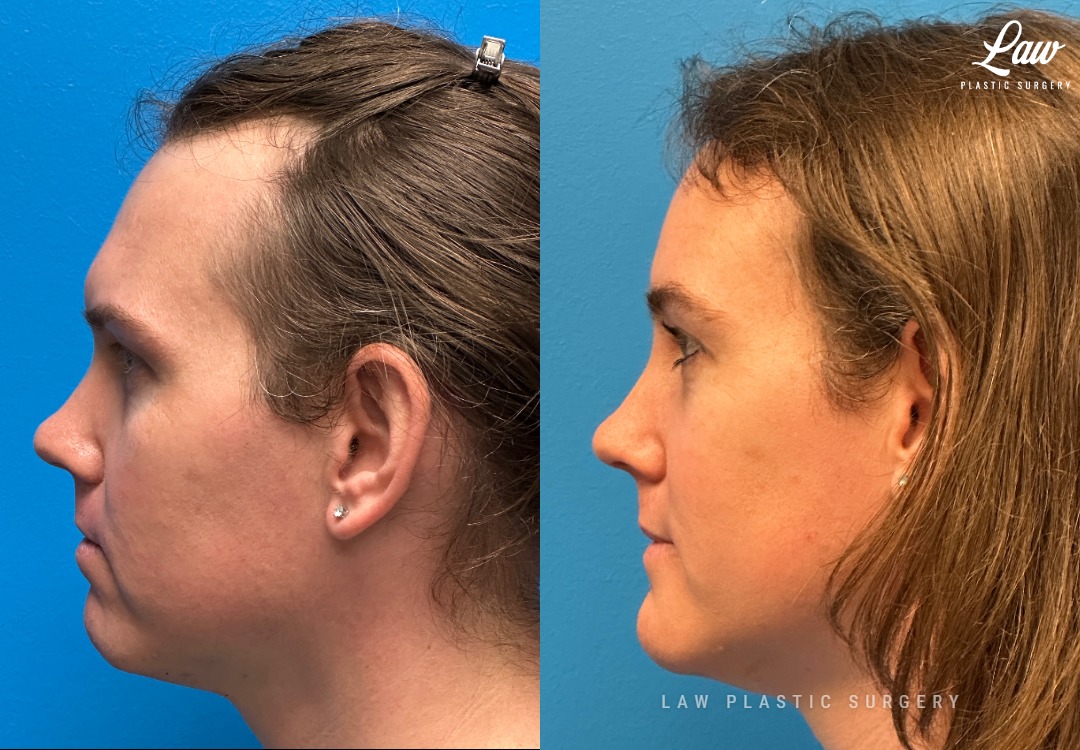 Facial Feminization Before & After Photo. Surgery performed in Dallas, TX at Law Plastic Surgery.