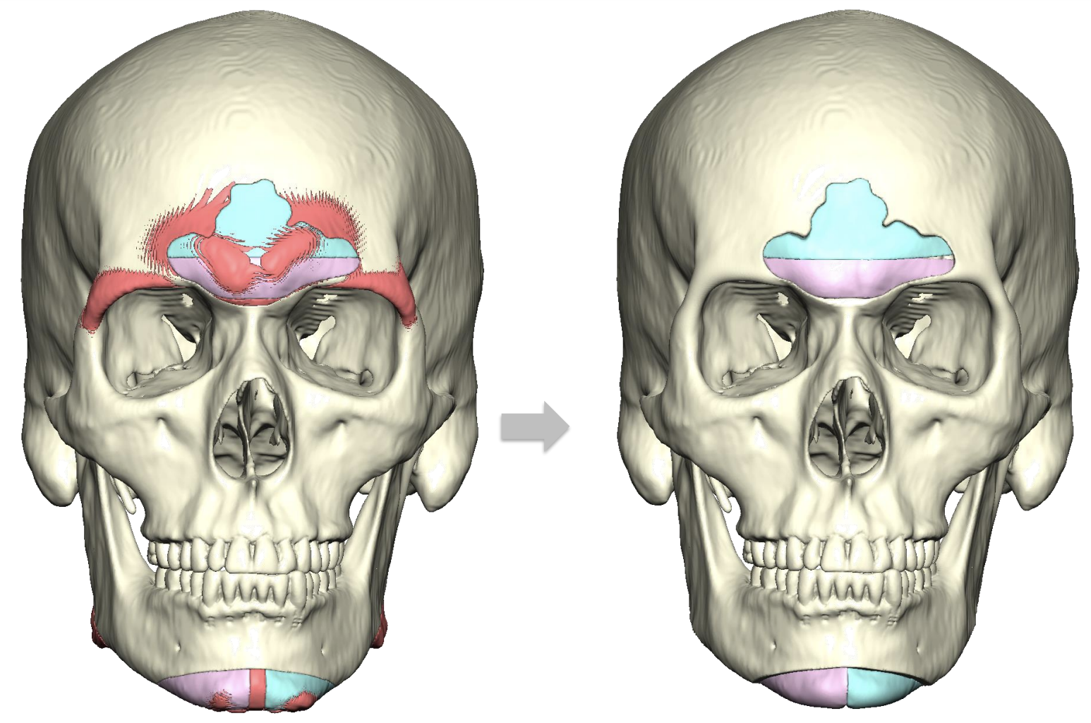 Facial Feminization Before & After Photo. Surgery performed in Dallas, TX at Law Plastic Surgery.