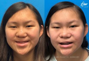 Jaw Surgery Before and After Photo. Surgery performed in Dallas, TX at Law Plastic Surgery.