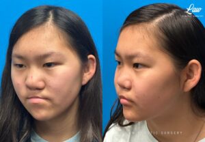 Jaw Surgery Before and After Photo. Surgery performed in Dallas, TX at Law Plastic Surgery.