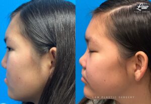 Jaw Surgery Before and After Photo. Surgery performed in Dallas, TX at Law Plastic Surgery.