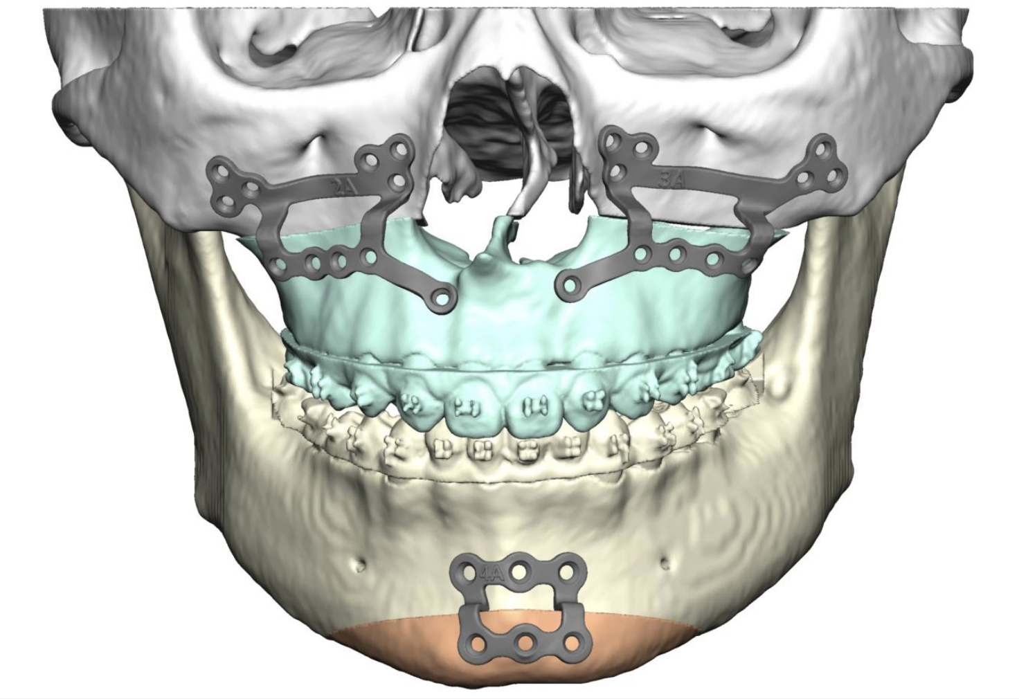 Jaw Surgery Before and After Photo. Surgery performed in Dallas, TX at Law Plastic Surgery.