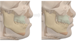 Jaw Surgery Before and After Photo. Surgery performed in Dallas, TX at Law Plastic Surgery.