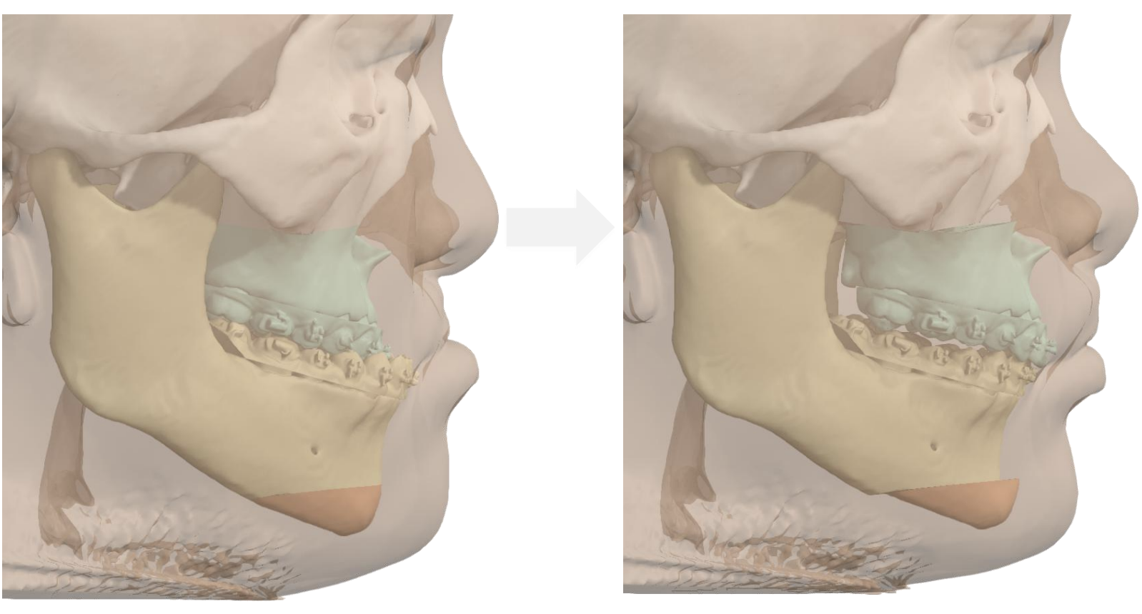 Jaw Surgery Before and After Photo. Surgery performed in Dallas, TX at Law Plastic Surgery.