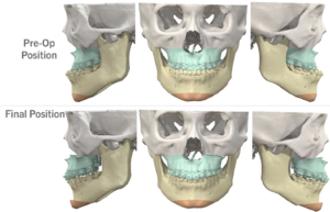 Jaw Surgery Before and After Photo. Surgery performed in Dallas, TX at Law Plastic Surgery.