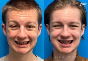Jaw Surgery Before and After Photo. Surgery performed in Dallas, TX at Law Plastic Surgery.