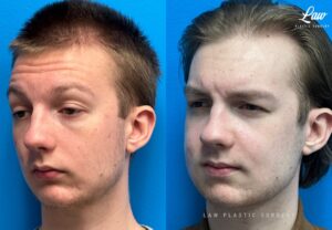 Jaw Surgery Before and After Photo. Surgery performed in Dallas, TX at Law Plastic Surgery.