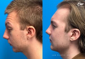 Jaw Surgery Before and After Photo. Surgery performed in Dallas, TX at Law Plastic Surgery.