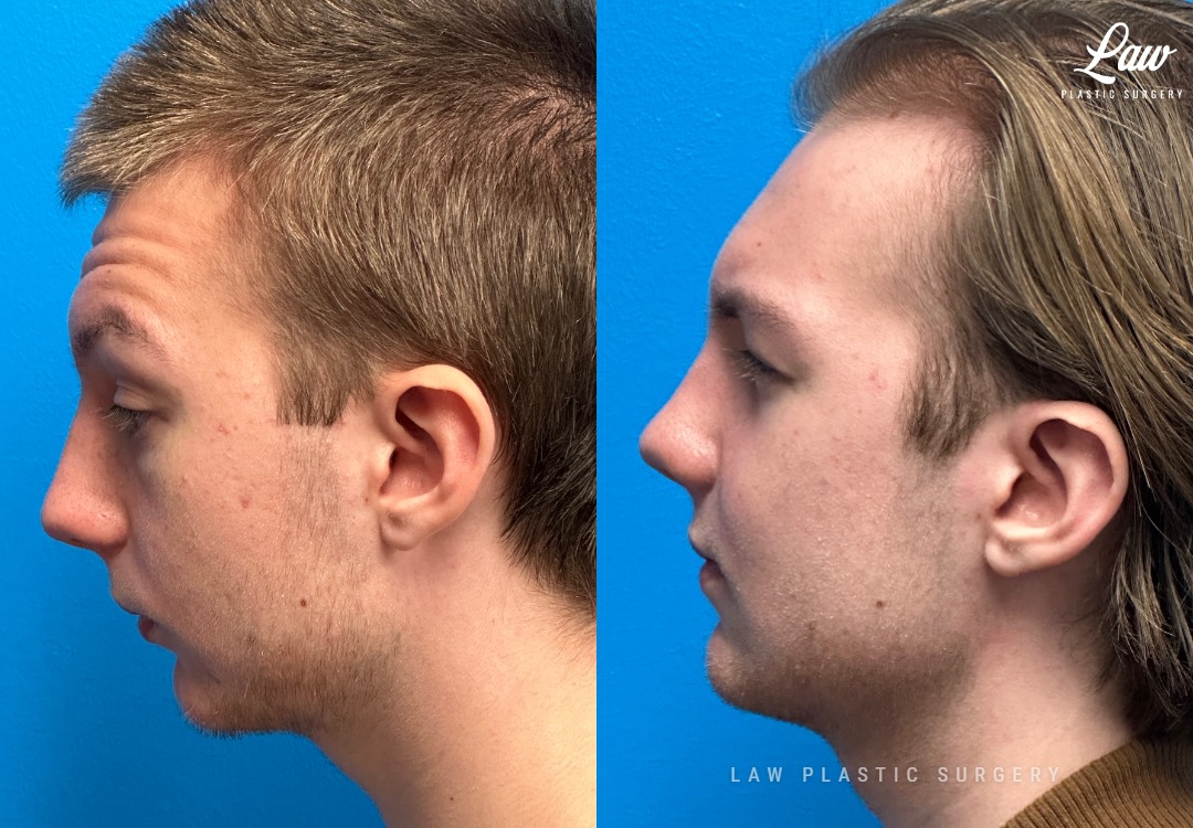 Jaw Surgery Before and After Photo. Surgery performed in Dallas, TX at Law Plastic Surgery.