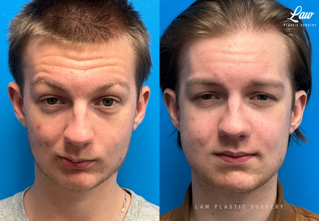 Jaw Surgery Before and After Photo. Surgery performed in Dallas, TX at Law Plastic Surgery.