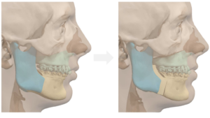 Jaw Surgery Before and After Photo. Surgery performed in Dallas, TX at Law Plastic Surgery.