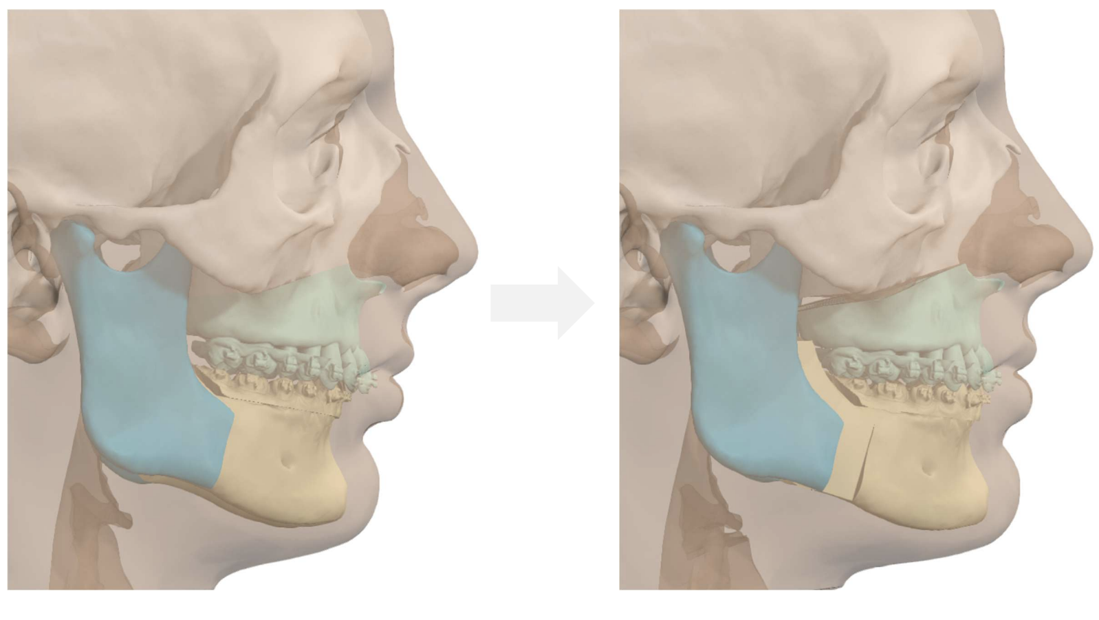 Jaw Surgery Before and After Photo. Surgery performed in Dallas, TX at Law Plastic Surgery.