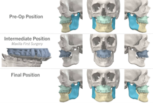 Jaw Surgery Before and After Photo. Surgery performed in Dallas, TX at Law Plastic Surgery.