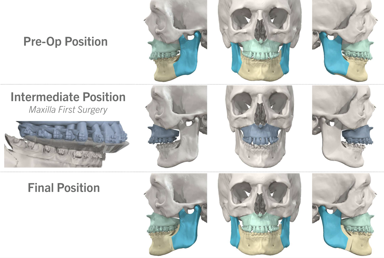Jaw Surgery Before and After Photo. Surgery performed in Dallas, TX at Law Plastic Surgery.
