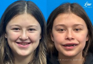Jaw Surgery Before and After Photo. Surgery performed in Dallas, TX at Law Plastic Surgery.