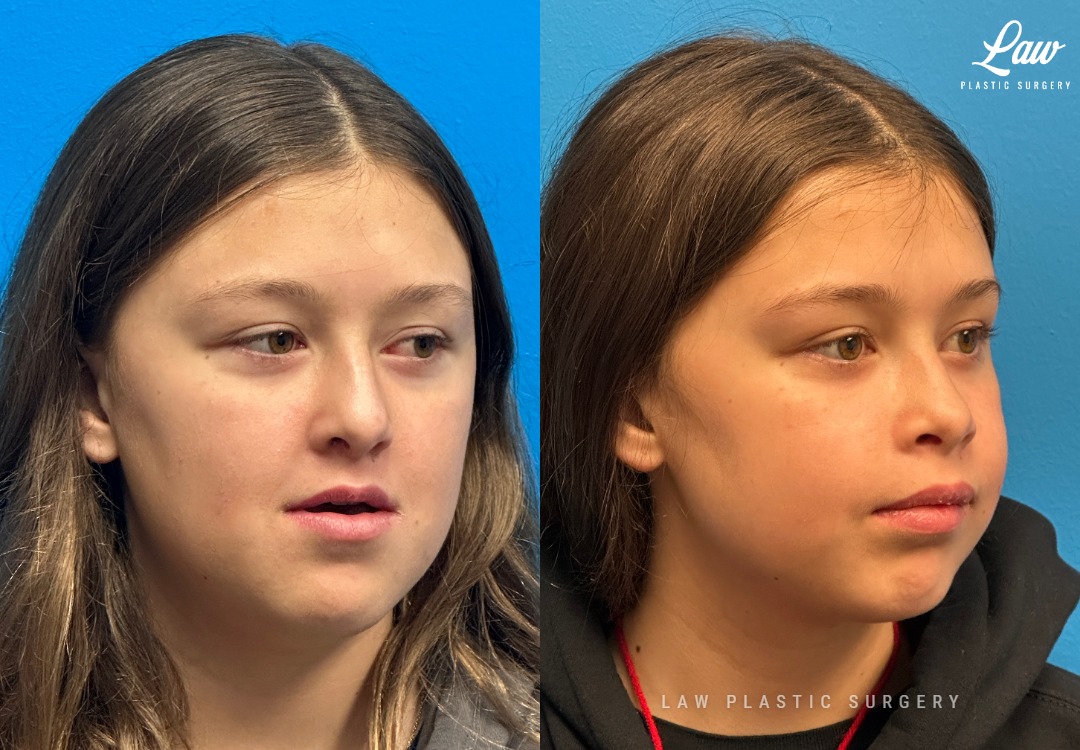 Jaw Surgery Before and After Photo. Surgery performed in Dallas, TX at Law Plastic Surgery.