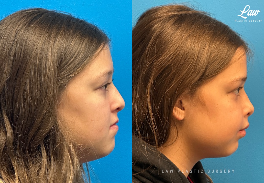 Jaw Surgery Before and After Photo. Surgery performed in Dallas, TX at Law Plastic Surgery.