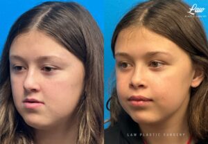 Jaw Surgery Before and After Photo. Surgery performed in Dallas, TX at Law Plastic Surgery.