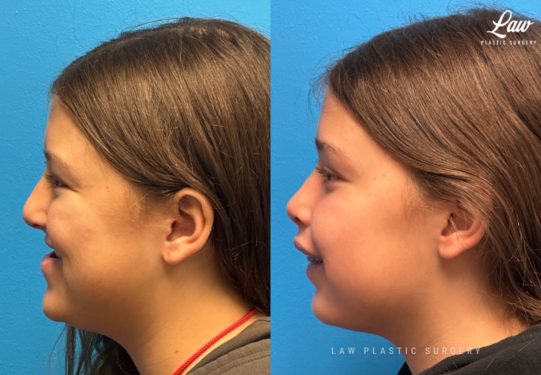 Jaw Surgery Before and After Photo. Surgery performed in Dallas, TX at Law Plastic Surgery.