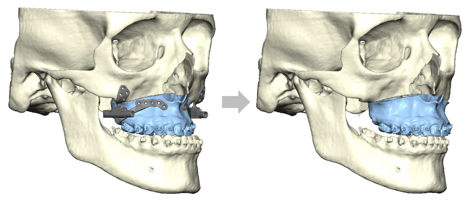 Jaw Surgery Before and After Photo. Surgery performed in Dallas, TX at Law Plastic Surgery.