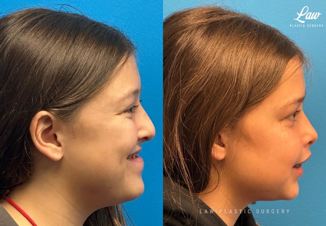 Jaw Surgery Before and After Photo. Surgery performed in Dallas, TX at Law Plastic Surgery.