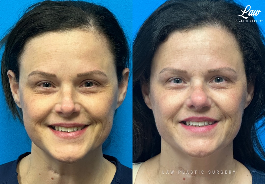 Septoplasty Before & After Photo. Surgery performed in Dallas, TX at Law Plastic Surgery.