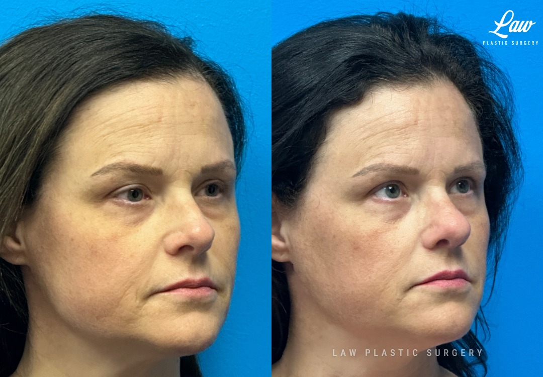 Septoplasty Before & After Photo. Surgery performed in Dallas, TX at Law Plastic Surgery.