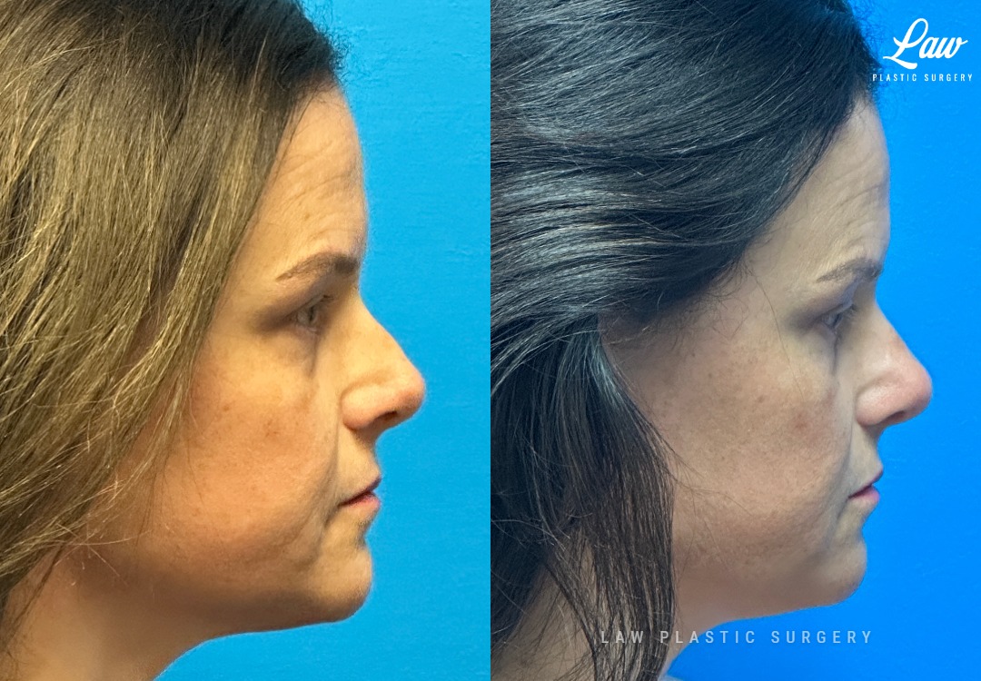Septoplasty Before & After Photo. Surgery performed in Dallas, TX at Law Plastic Surgery.