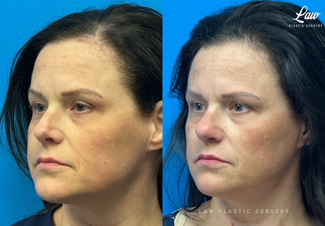 Septoplasty Before & After Photo. Surgery performed in Dallas, TX at Law Plastic Surgery.