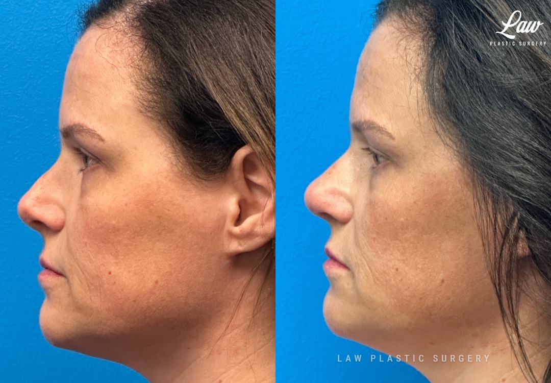 Septoplasty Before & After Photo. Surgery performed in Dallas, TX at Law Plastic Surgery.