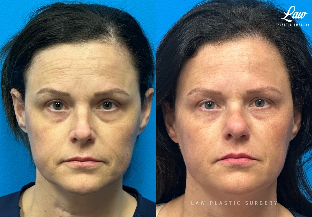 Septoplasty Before & After Photo. Surgery performed in Dallas, TX at Law Plastic Surgery.