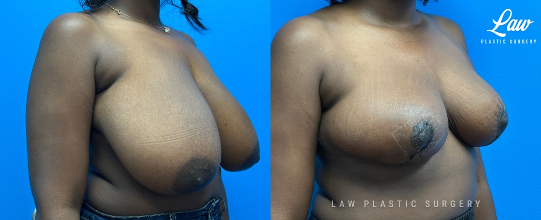 Breast Reduction Before and After Photo. Surgery performed in Dallas, TX at Law Plastic Surgery.