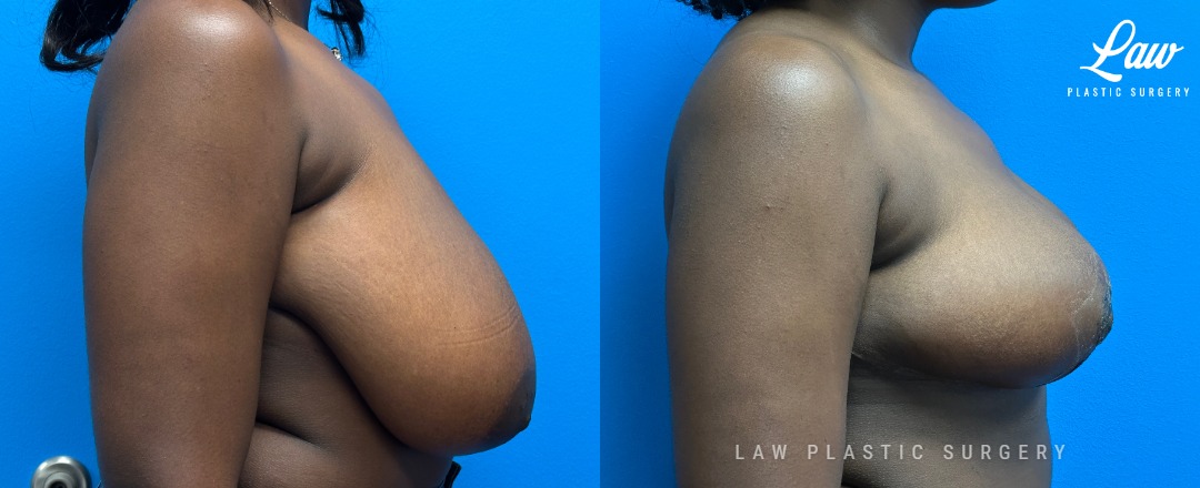 Breast Reduction Before and After Photo. Surgery performed in Dallas, TX at Law Plastic Surgery.