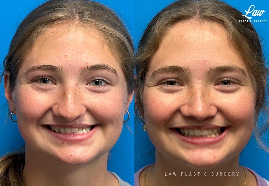 Cleft Rhinoplasty (Cleft Nose Surgery) Before & After Photo. Surgery performed in Dallas, TX at Law Plastic Surgery.