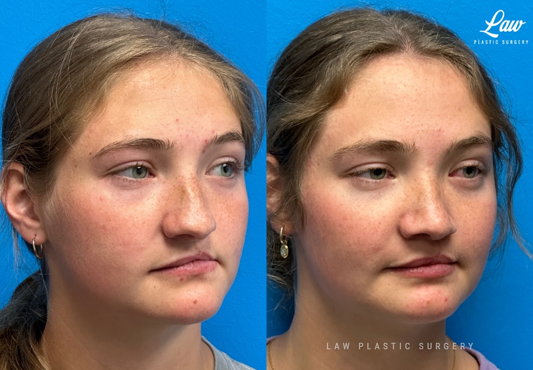 Cleft Rhinoplasty (Cleft Nose Surgery) Before & After Photo. Surgery performed in Dallas, TX at Law Plastic Surgery.