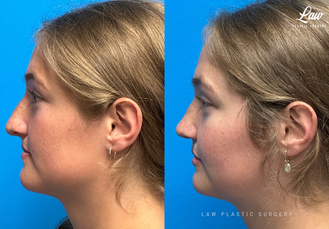Cleft Rhinoplasty (Cleft Nose Surgery) Before & After Photo. Surgery performed in Dallas, TX at Law Plastic Surgery.