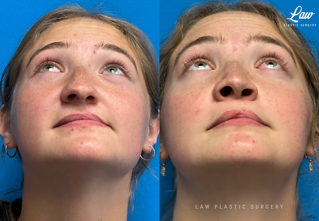 Cleft Rhinoplasty (Cleft Nose Surgery) Before & After Photo. Surgery performed in Dallas, TX at Law Plastic Surgery.